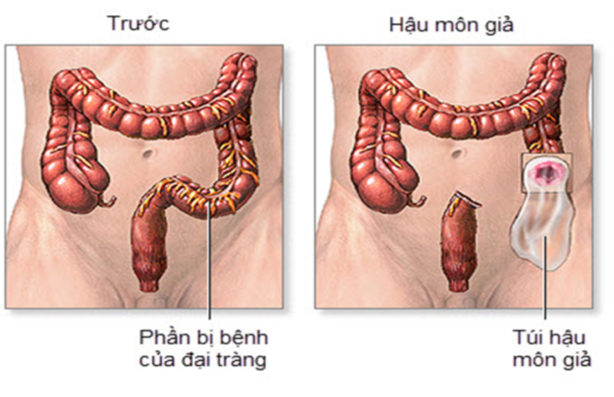 CHĂM SÓC HẬU MÔN NHÂN TẠO